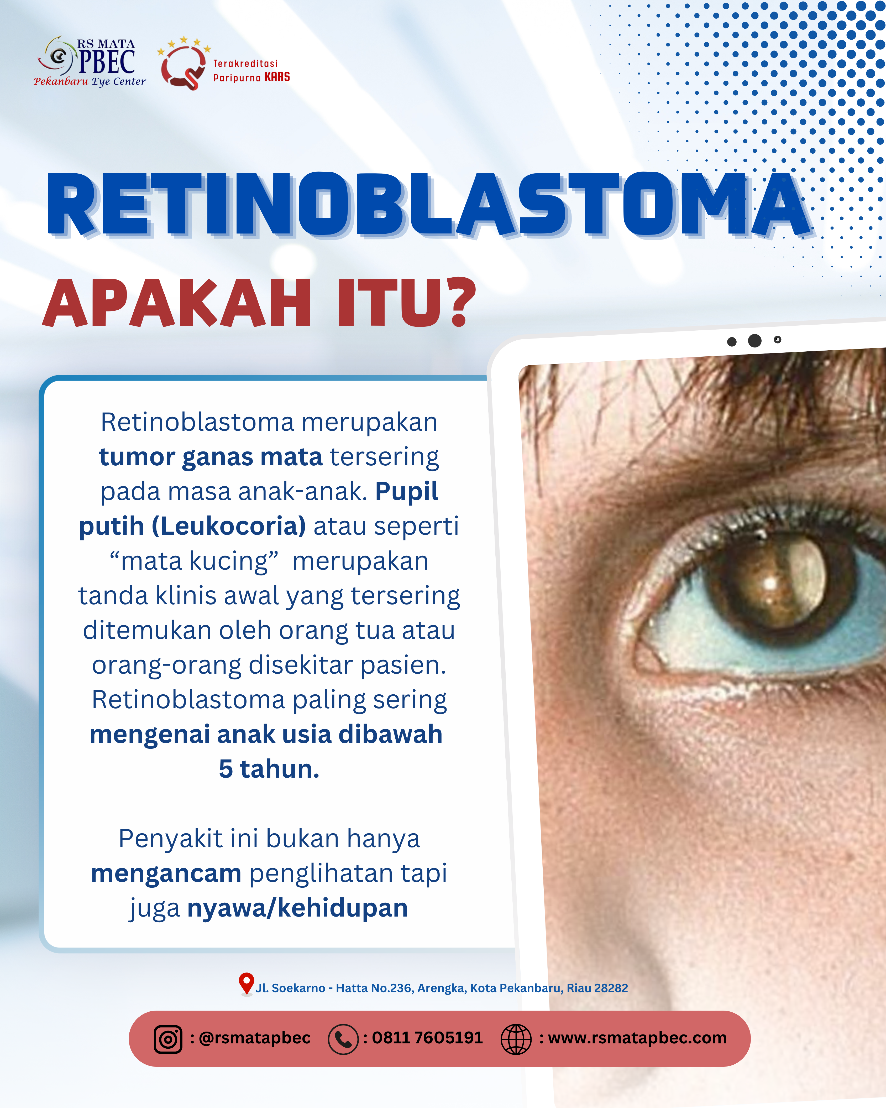 Retinoblastoma pada Anak: Kenali Sejak Dini untuk Menyelamatkan Penglihatan