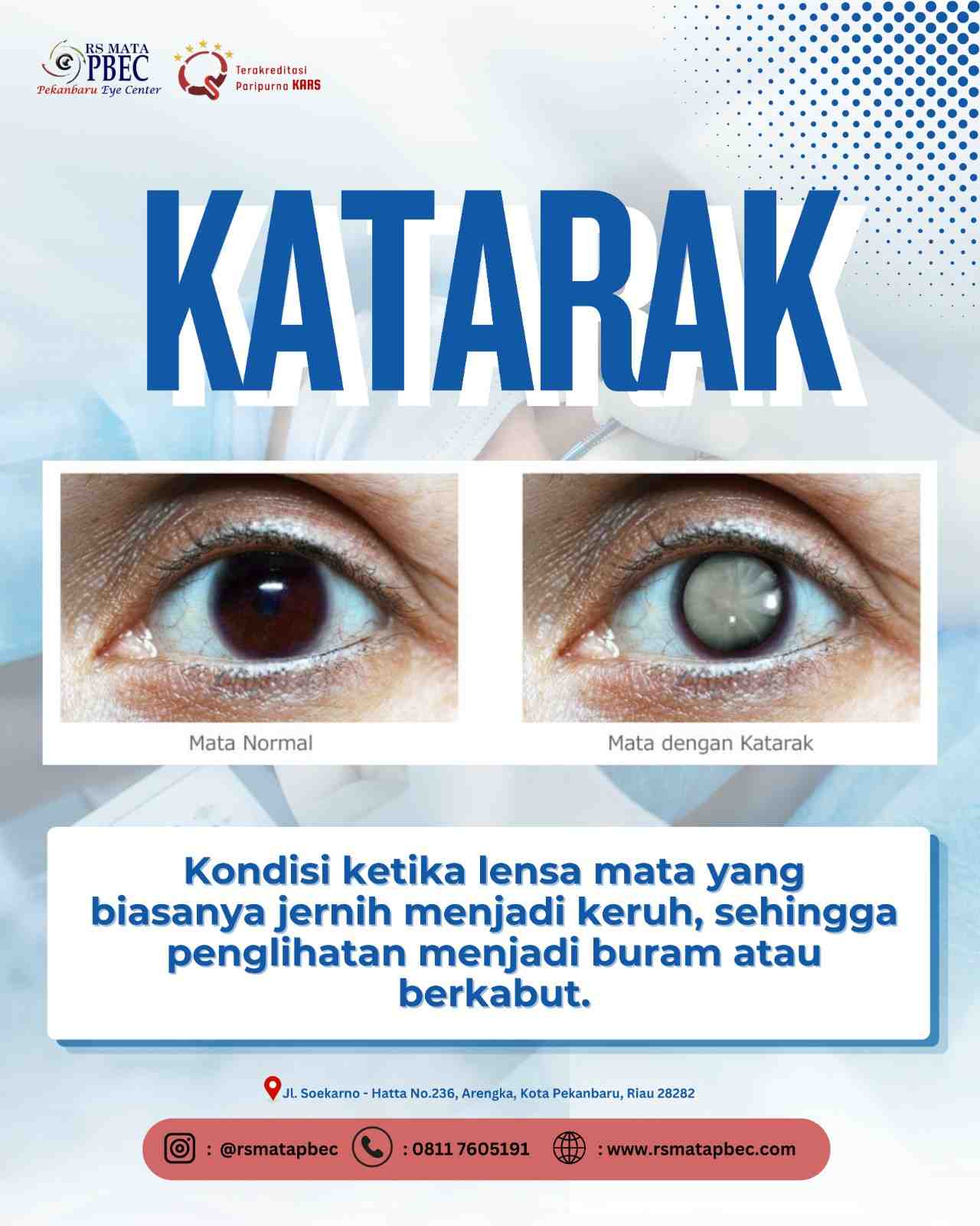 Katarak: Penyebab, Gejala, dan Pengobatan