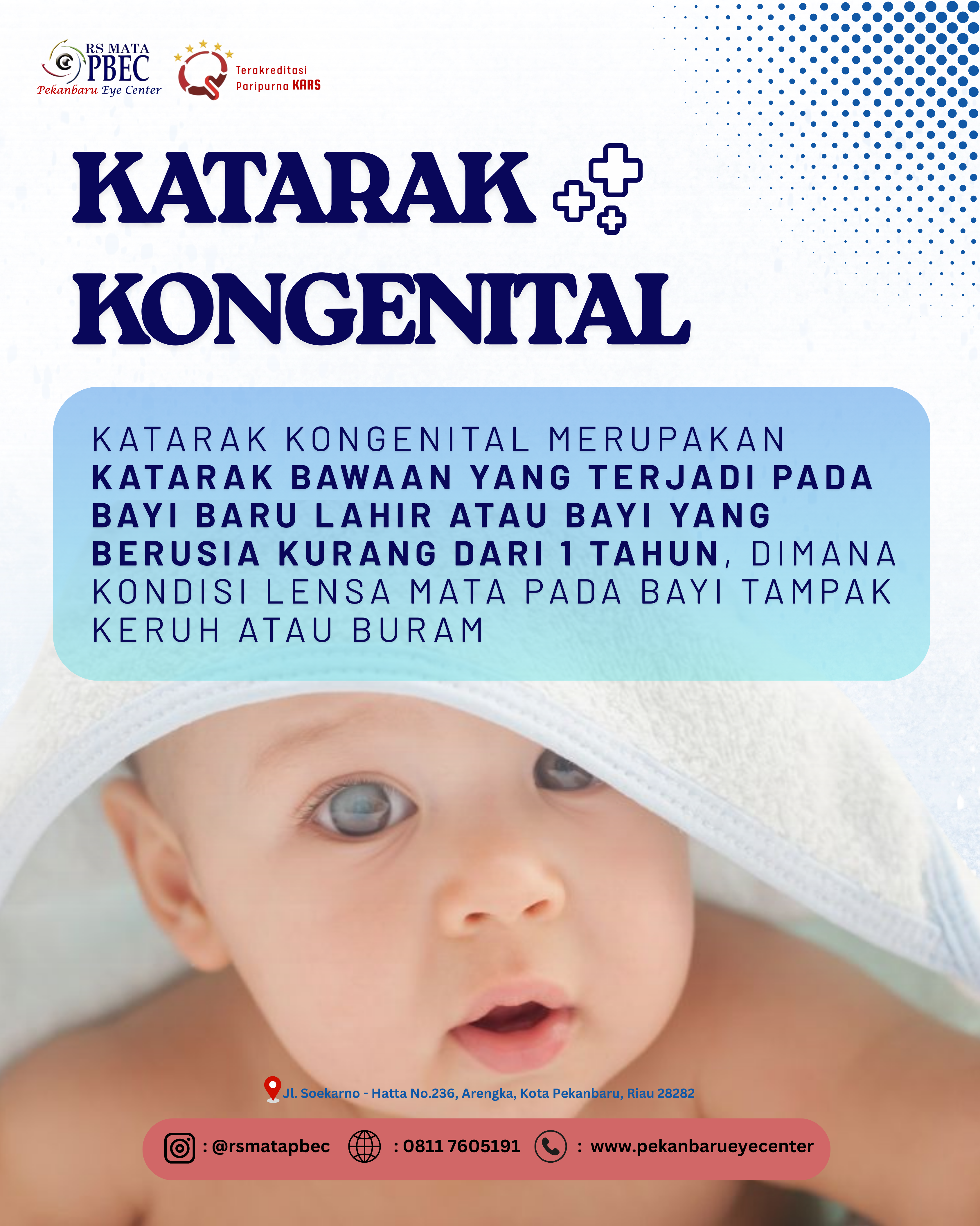 Katarak Kongenital: Penyebab, Gejala, dan Penanganannya