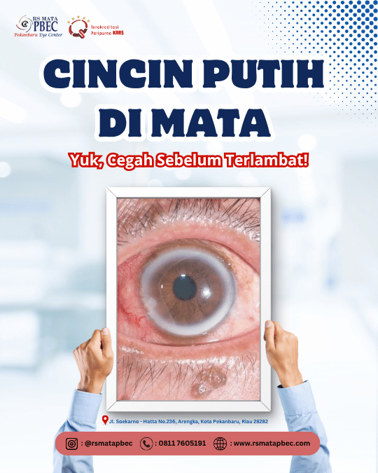 Cincin Putih di Mata, Cegah Sebelum Terlambat!