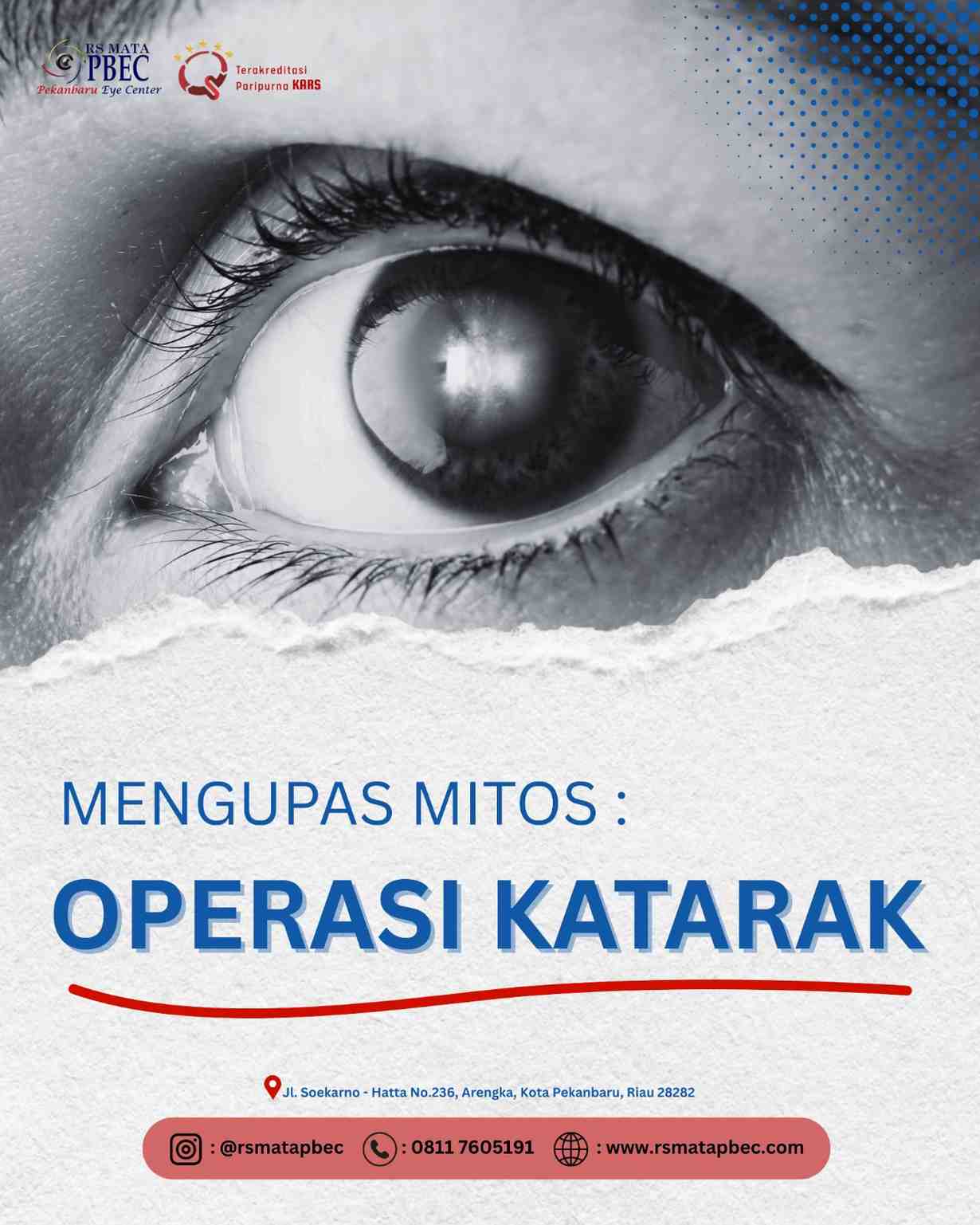 Mengupas Mitos Operasi Katarak