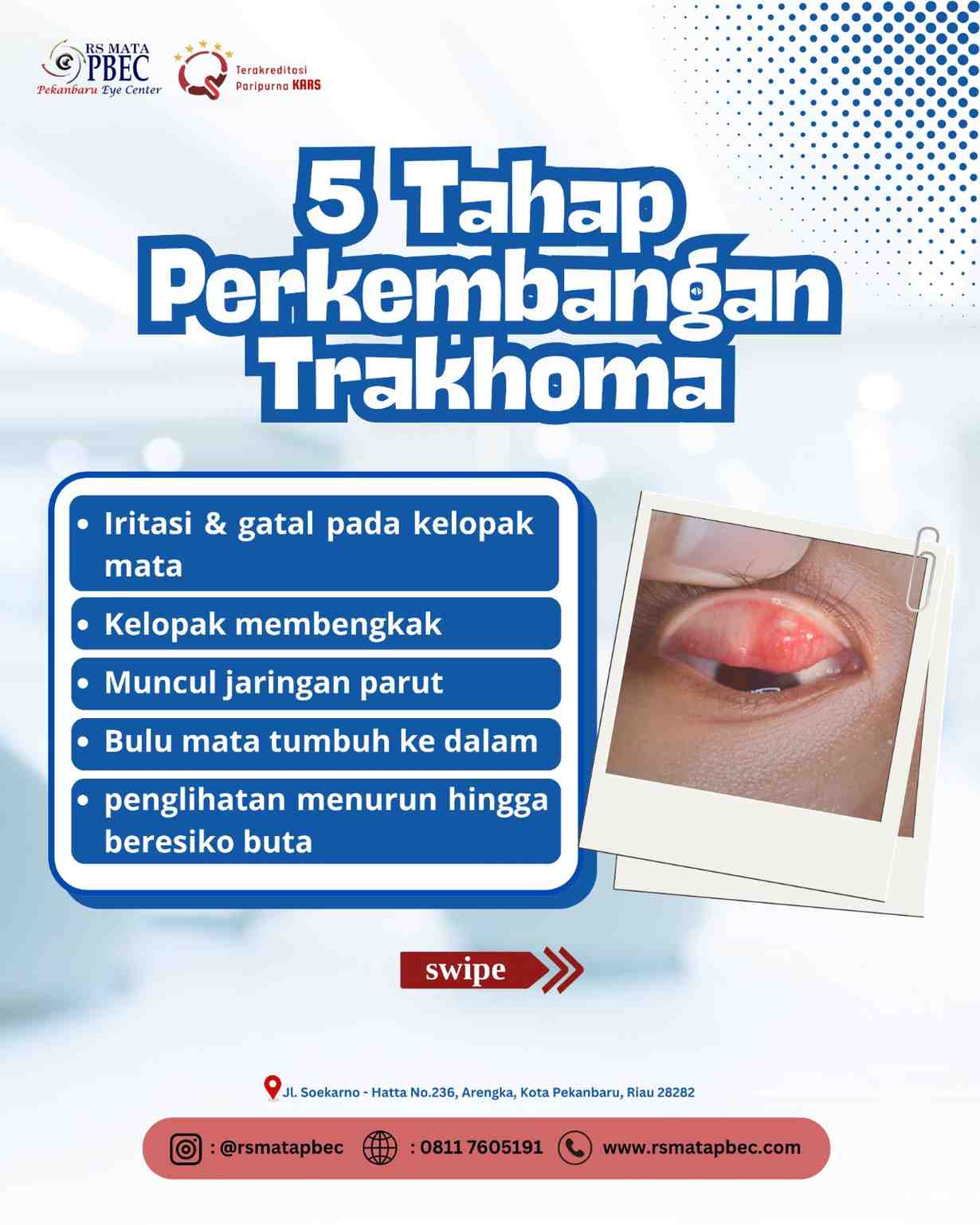 5 Tahap Perkembangan Trakhoma yang Perlu Diwaspadai