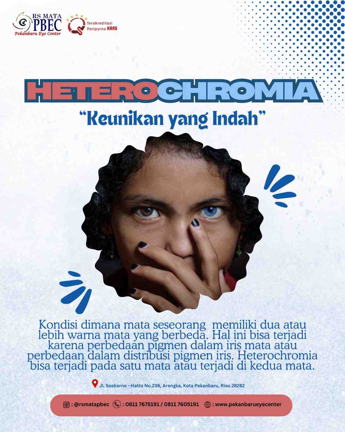 Heterochromia: Kondisi Unik pada Mata dengan Warna Berbeda