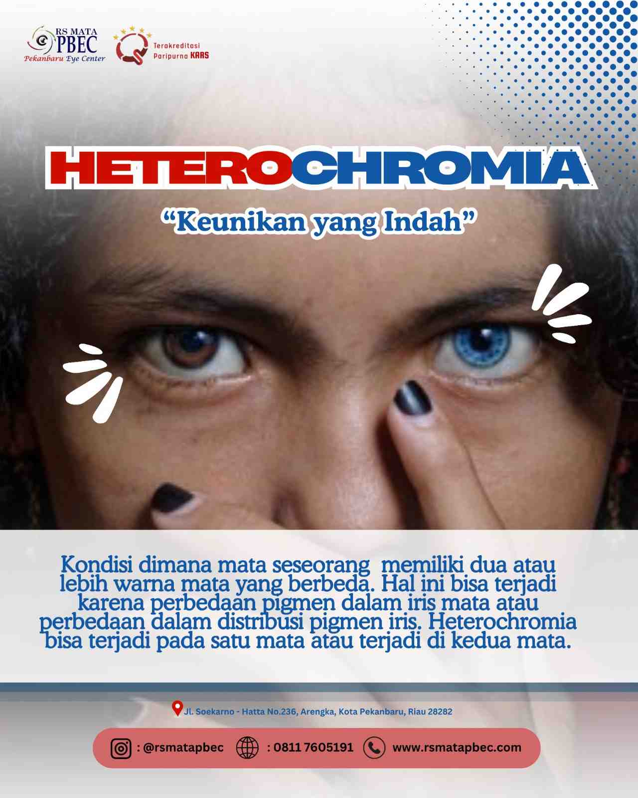 HETEROCHROMIA : 