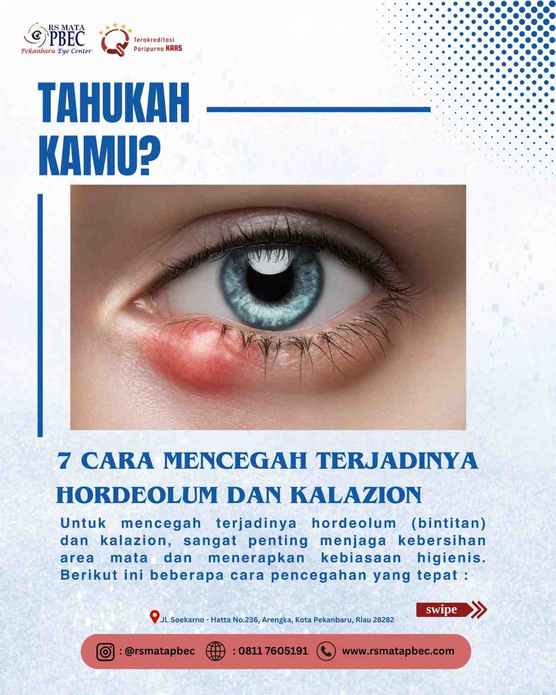 7 CARA MENCEGAH TERJADINYA HORDEOLUM DAN KALAZION
