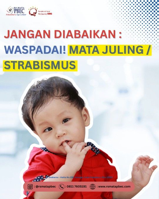Jangan Biarkan: Waspadai! Mata Juling / Strabismus