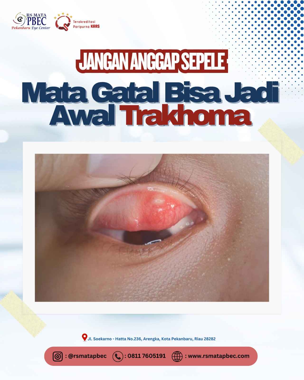 Jangan Anggap Sepele! Mata Gatal Bisa Jadi Awal Trakhoma